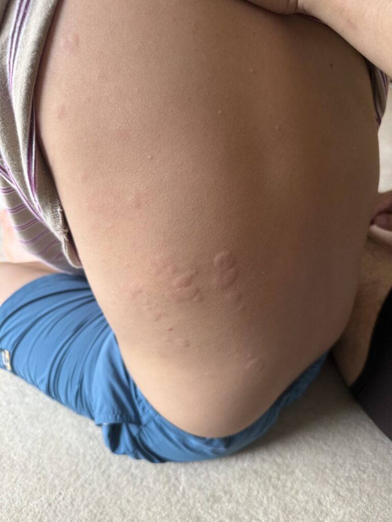 ぶらぴこの腕に出た蕁麻疹の様子